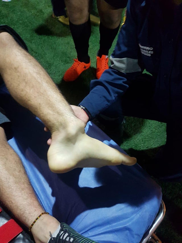 VIDEO: Đồng đội của James Rodriguez gặp phải chấn thương kinh hoàng ở cổ chân - Ảnh 2.