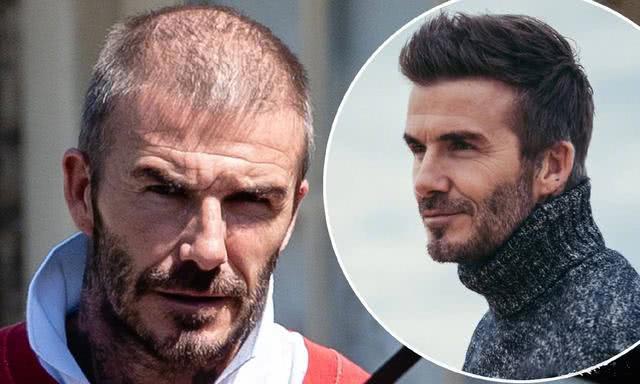 Beckham và những ngôi sao bóng đá tút lại vẻ đẹp trai nhờ phương pháp cấy tóc - Ảnh 1.