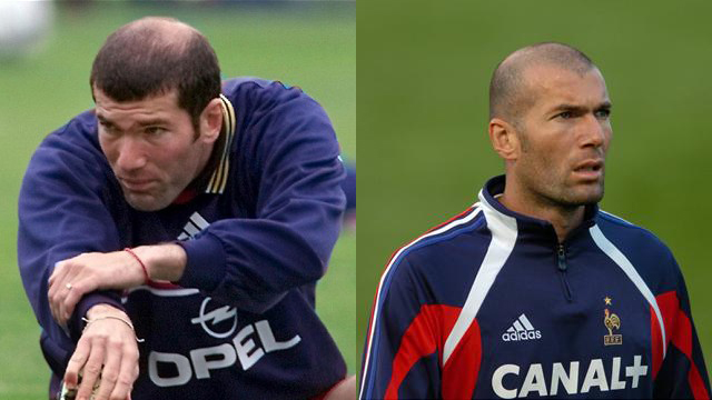 Beckham và những ngôi sao bóng đá tút lại vẻ đẹp trai nhờ phương pháp cấy tóc - Ảnh 9.