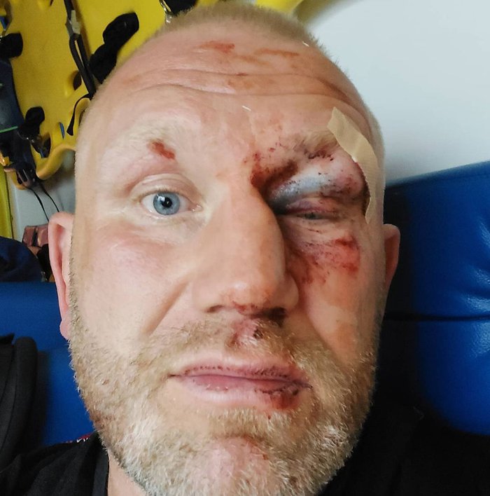 Cựu võ sĩ Bellator vỡ hốc mắt, gãy mũi sau khi bị võ sĩ UFC hành hung  - Ảnh 1.