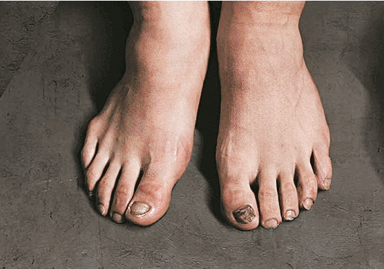 Vì vinh quang, Son Heung-min trả giá bằng đôi bàn chân biến dạng - Ảnh 1.
