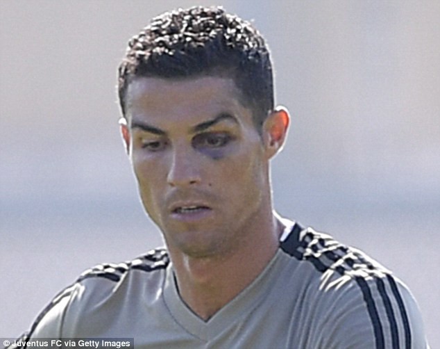 Ronaldo tập luyện với một bên mắt tím bầm - Ảnh 2.