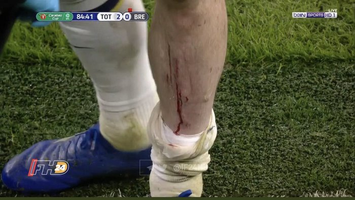 Cận cảnh pha vào bóng nguy hiểm khiến ống đồng sao Tottenham chảy máu - Ảnh 5.