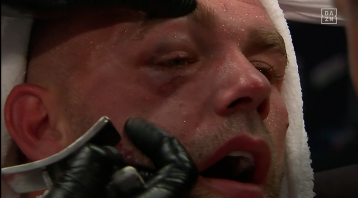 Billy Joe Saunders bị vỡ xương hốc mắt, phải nhập viện khẩn cấp sau thất bại trước Canelo Alvarez - Ảnh 1.