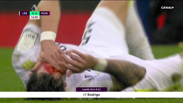 Cầu thủ Leeds chảy máu đầm đìa vì va chạm với sao MU - Ảnh 2.