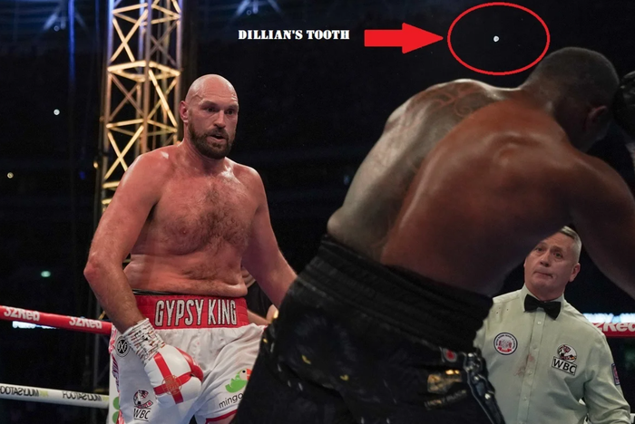 Cú KO của Tyson Fury khiến Dillian Whyte bay mất răng? - Ảnh 1.