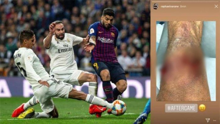 Nhà vô địch World Cup 2018 hé lộ chấn thương rợn tóc gáy sau thảm bại 0-3 của Real Madrid - Ảnh 1.