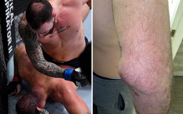 Cựu vương Mauricio Rua gặp chấn thương tay kinh hoàng sau trận thua tại UFC