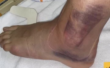 1 ngày sau chấn thương kinh hoàng của Ceballos: Cổ chân bầm tím, sưng tấy gây sợ hãi