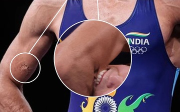 Đô vật cắn người tại Olympic, dấu răng hằn trên tay đối thủ