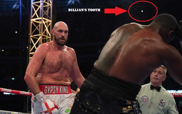 Cú KO của Tyson Fury khiến Dillian Whyte bay mất răng?