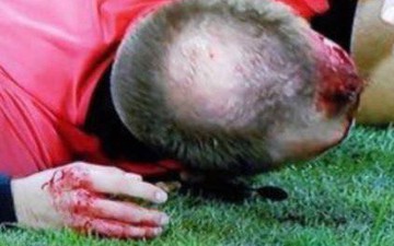 Trọng tài Europa League bị cổ động viên ném vỡ đầu