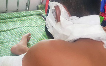 Ba cầu thủ trẻ Việt Nam bị bỏng nặng vì bóng bay phát nổ
